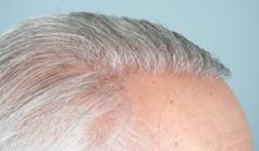 Before Hair Transplant&nbsp;Hairlines